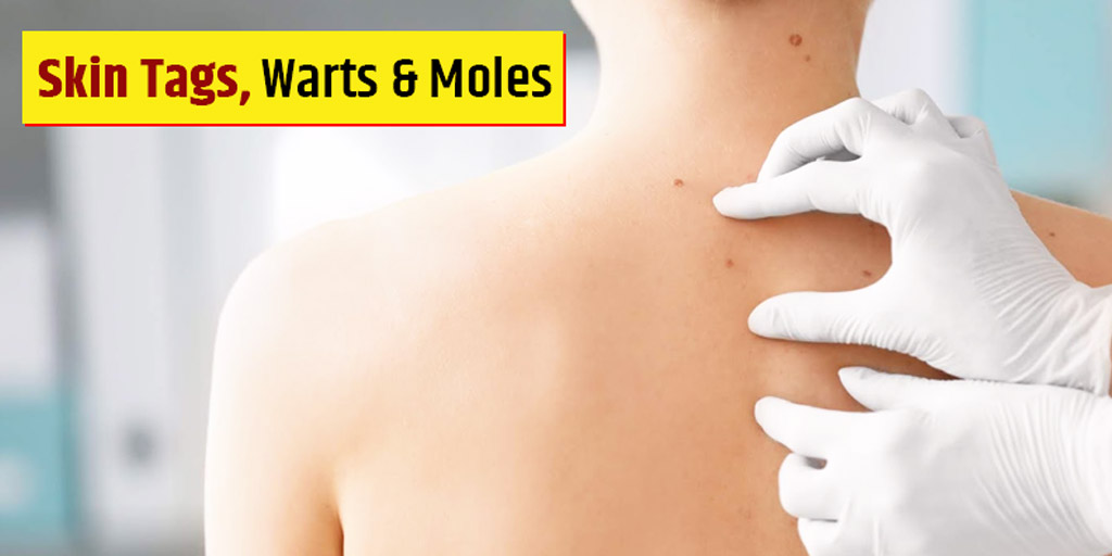 How Much Does It Cost To Get A Mole Removed