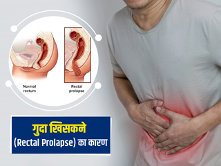 Rectal prolapse: 50 के बाद महिलाओं में ज्यादा होता है गुदा (मलद्वार) बाहर आने का खतरा, जानें क्या है ये बीमारी