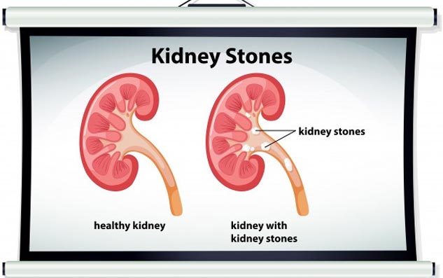 Inside_kidneystones