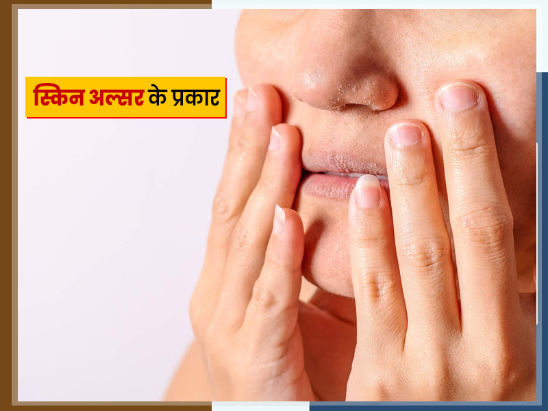 त्वचा पर छाले या फोड़े (स्किन अल्सर) क्यों होते हैं? जानें इसके कारण, लक्षण, इलाज और घरेलू उपचार