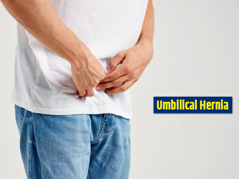 Umbilical Hernia: Know Various Causes, Symptoms, Risks, Diagnosis