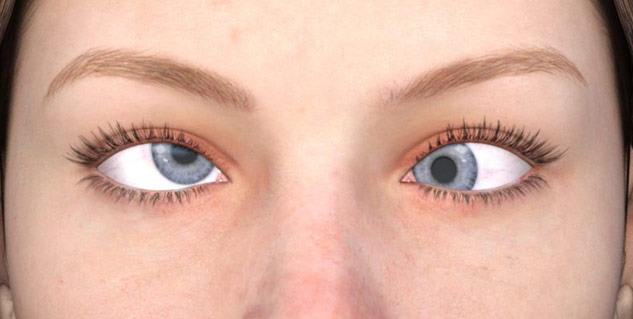 lazy eye