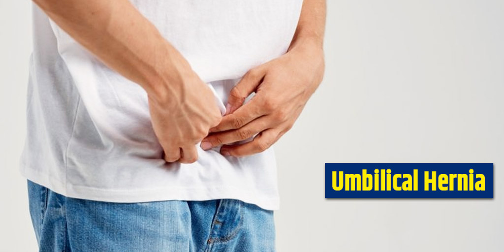 Umbilical Hernia Know Various Causes Symptoms Risks Diagnosis And