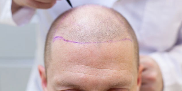 Hair-Transplant-myths-facts