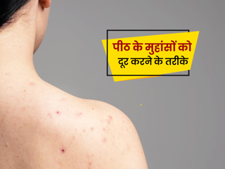 Back Acne: पीठ के मुहांसे दूर करने के लिए अपनाएं ये 6 आयुर्वेदिक उपाय 