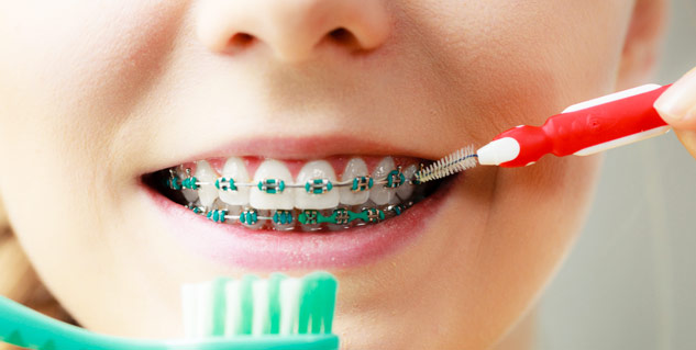 5 Tips on Caring for Metal Braces