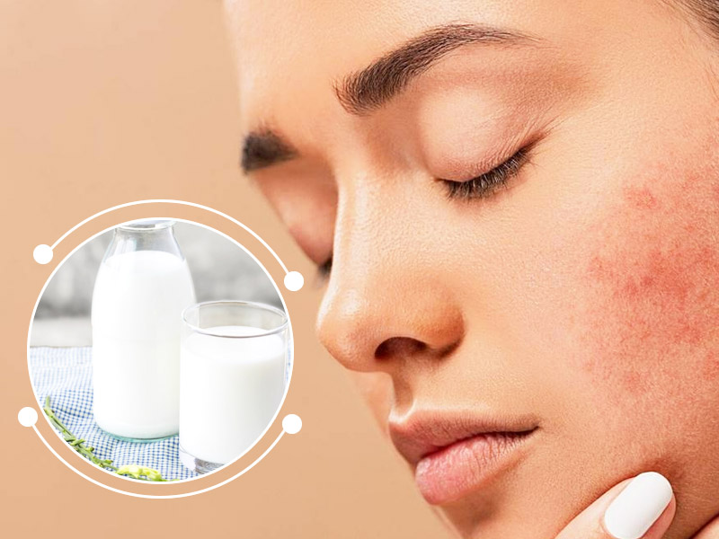 Can Milk Cause Acne? Here are 4 Ways To Treat Dairy Acne