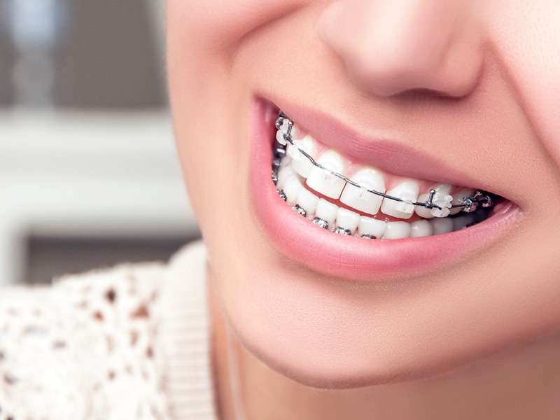 Braces Care Guide: 5 Tips To Take Care Of Your Metal Braces