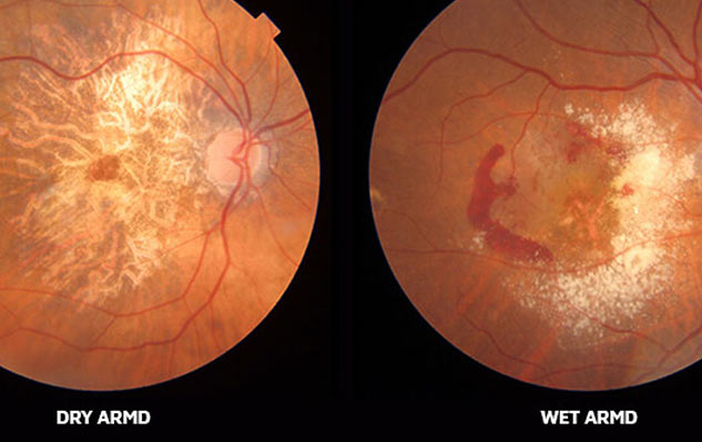 dry_wet_macular_degeneration