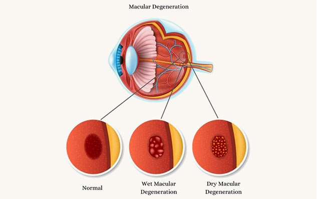 difference_between_macular_degeneration