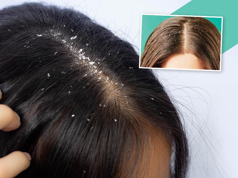 dandruff flakes in hair