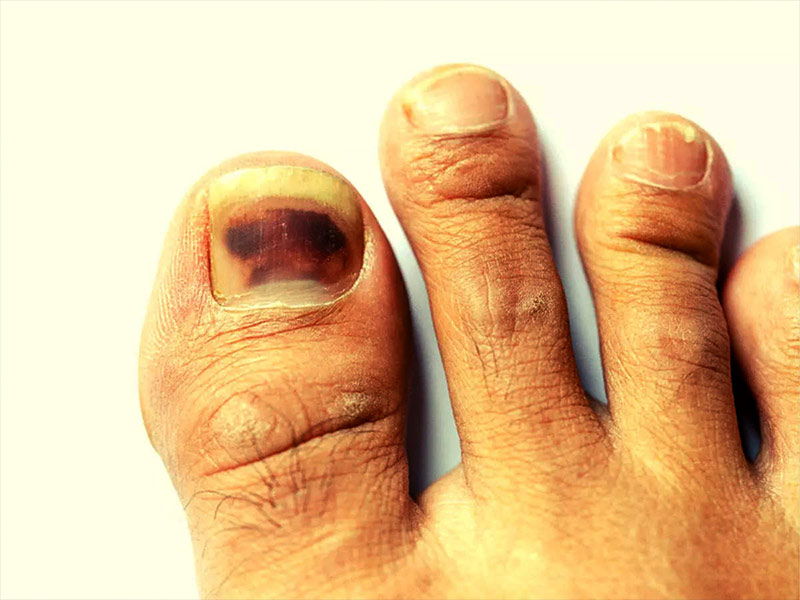 Toenail Fungus: Symptoms, Causes and Support Strategies