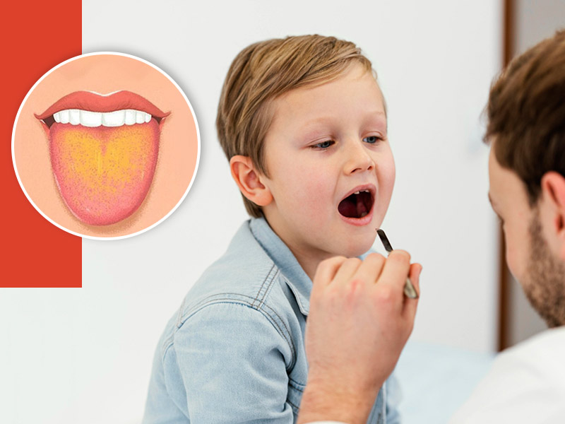 बच्चों की जीभ पर पीली पर्त (Yellow Tongue) के क्या कारण हो सकते हैं? डॉक्टर से जानें इसे साफ करने के उपाय