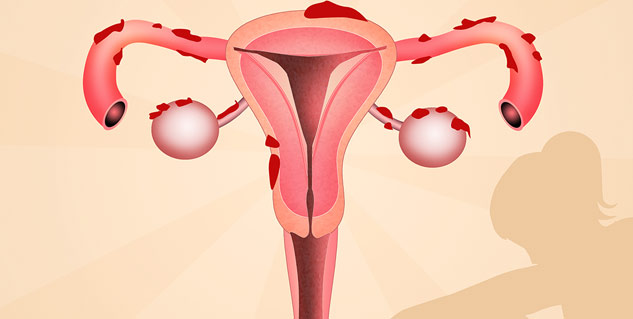 From Causes To Treatment Know Everything About Endometriosis From the ...