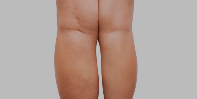 Insidekneesidefat