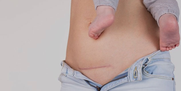  Cesarean-Delivery-Side-Effects
