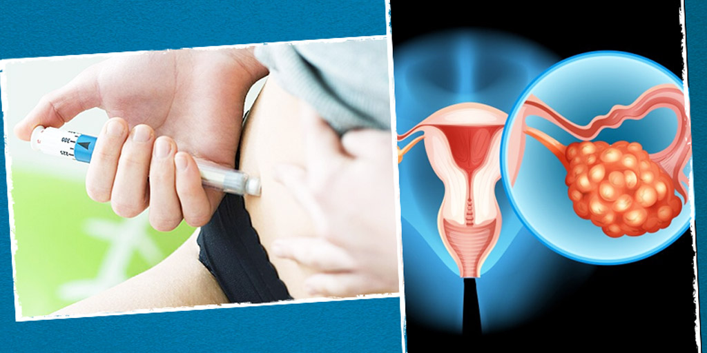 What Is Ovarian Stimulation In Ivf Know Its Relation To Fertility Onlymyhealth 1334