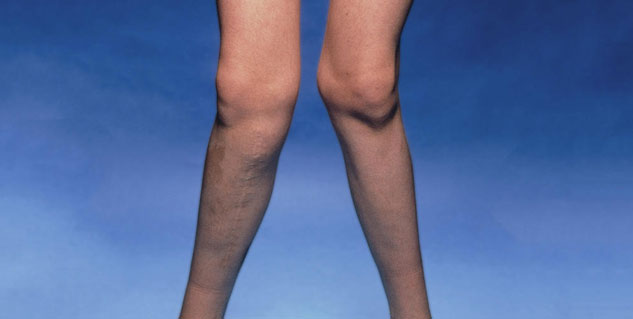 Knock-Knees-Causes-Symptoms-Treatment