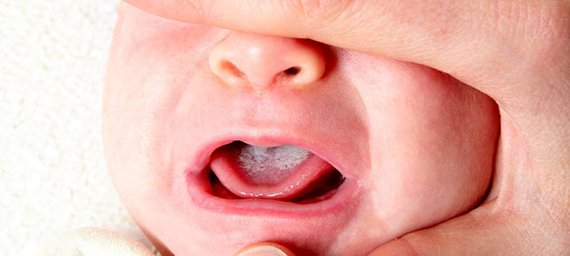Thrush-In-Babies