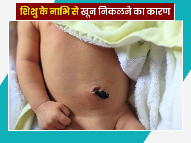 बच्चे का गर्भनाल गिरने के बाद नाभि से खून निकलना क्या चिंता की बात है? जानें डॉक्टर से