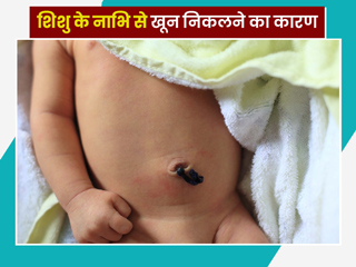 बच्चे का गर्भनाल गिरने के बाद नाभि से खून निकलना क्या चिंता की बात है? जानें डॉक्टर से