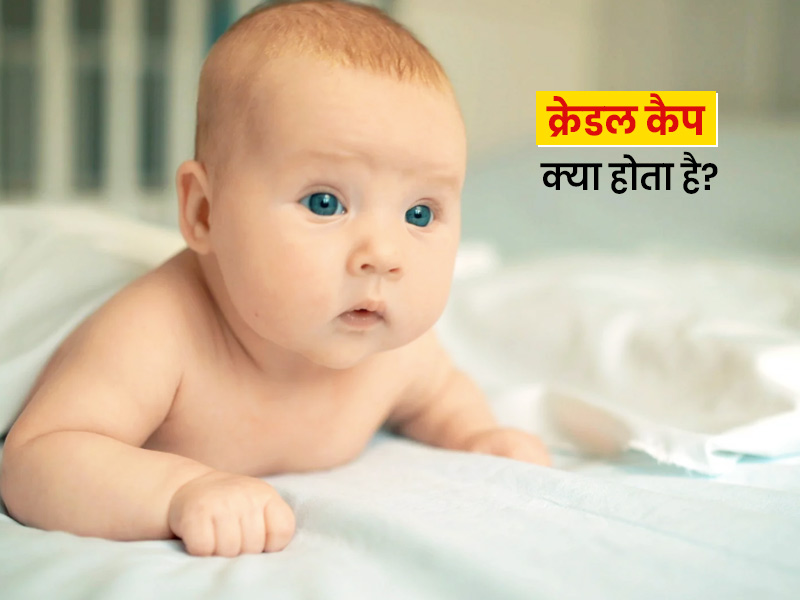 शिशु के सिर पर लाल-पीले धब्बे या पपड़ी हो सकते हैं क्रैडल कैप का संकेत? जानें इसके कारण, लक्षण और बचाव