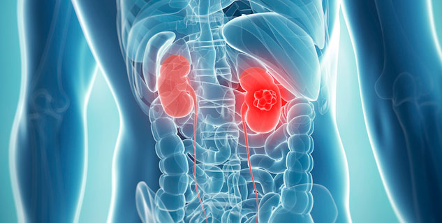 kidney cancer stages