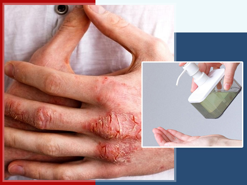 Can Frequent Hand Washing Lead To Eczema & Flare-Ups? Know Tips To Prevent It