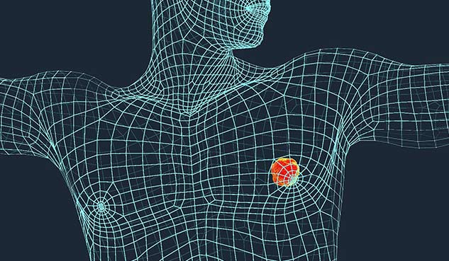 breast cancer in male