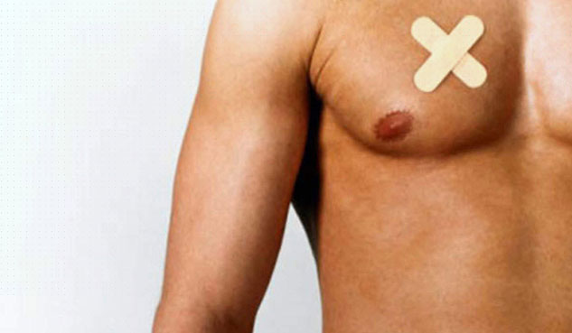 breast cancer in male