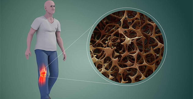 osteoporosis onlymyhealth