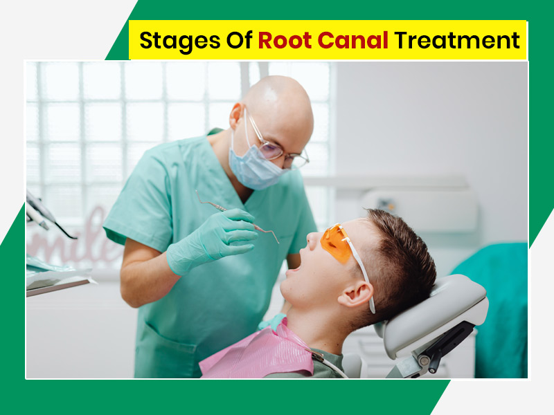 5 Stages Of Root Canal Treatment & The Correct Procedure OnlyMyHealth