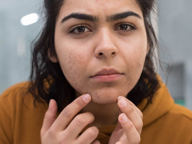 मह‍िलाओं की ठुड्डी (चिन) पर अनचाहे बाल क्‍यों आते हैं? जानें इस समस्‍या का कारण और इलाज