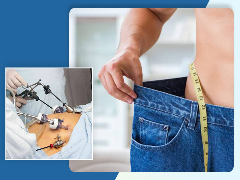 Bariatric Surgery: Types, Benefits & Precautions | OnlyMyHealth