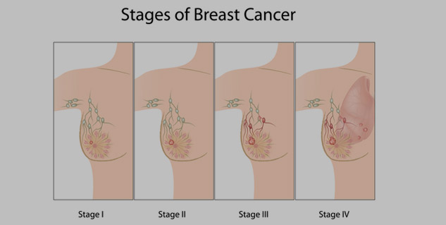stages_of_breast_cancer