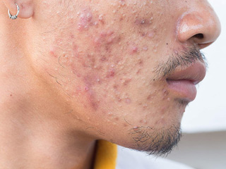 सामान्य मुंहासों से अलग होते हैं फंगल मुंहासे (Fungal Acne), जानें इसके पहचानने के तरीके और इलाज