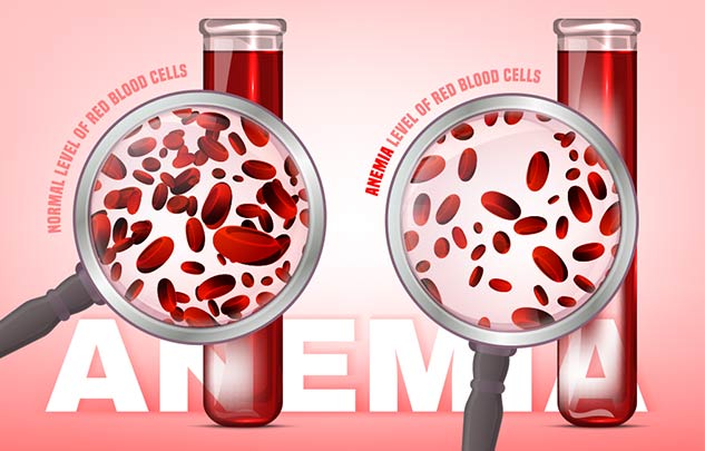 anemia