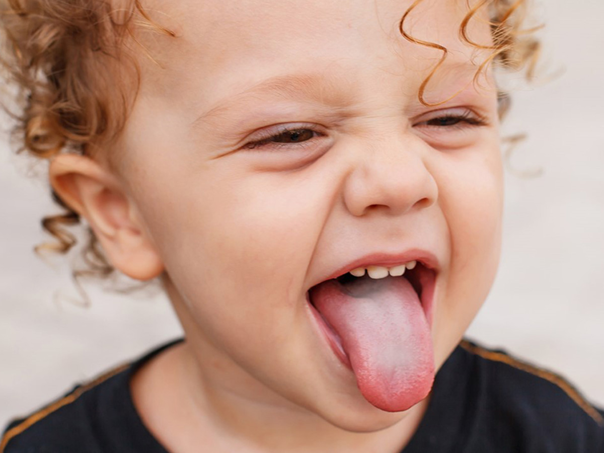 Thrush On Baby Tongue