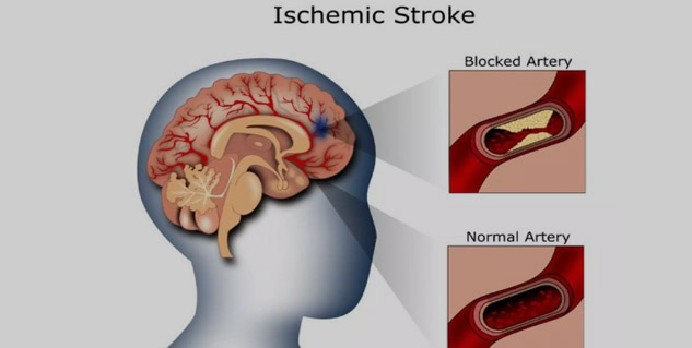 stroke in hindi