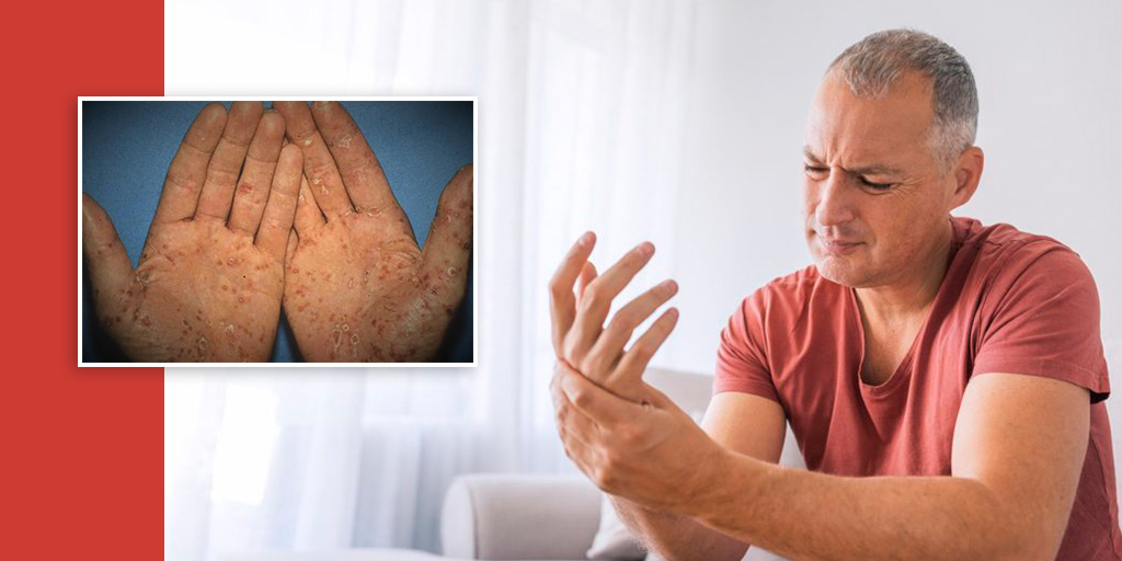 Reactive Arthritis Know About Symptoms And Causes For This Type Of