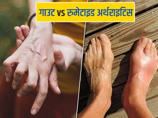 रुमेटाइड अर्थराइटिस और गाउट में क्या अंतर है? डॉक्टर से जानें दोनों के लक्षण और कारण
