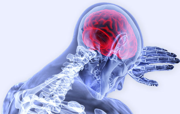 stroke_brain