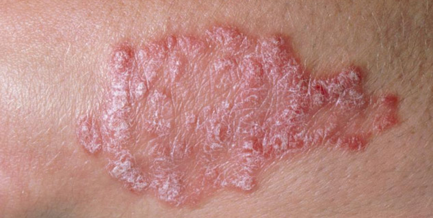 psoriasis