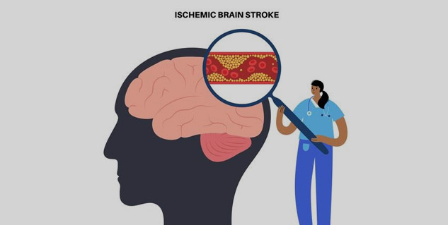 World Stroke Day is celebrated on October 29
