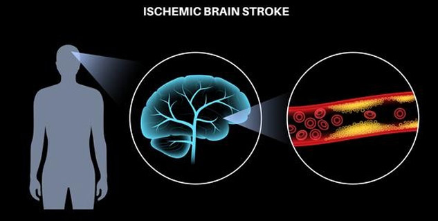 World Stroke Day 2021: Know What Causes Ischemic Strokes In Young ...