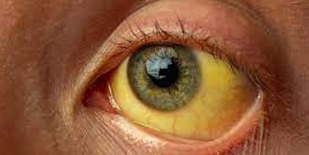 jaundice_pale_eyes