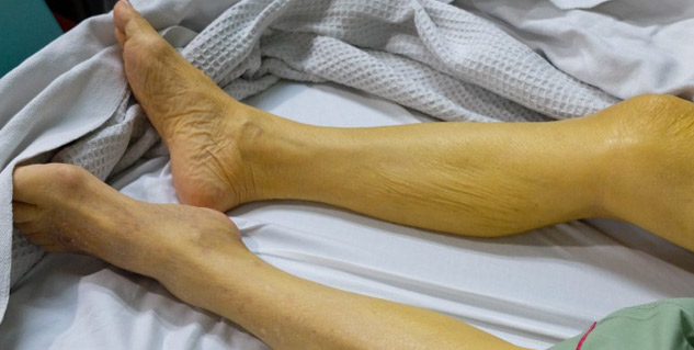 symptoms_of_jaundice