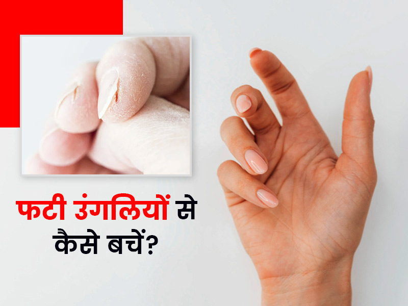 फटी उंगलियों से हैं परेशान तो आजमाएं ये 8 घरेलू उपचार
