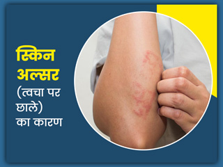 इन 5 कारणों से लोगों को होता है स्किन अल्सर (त्वचा पर छाले), जानें इसके लक्षण और बचाव के उपाय