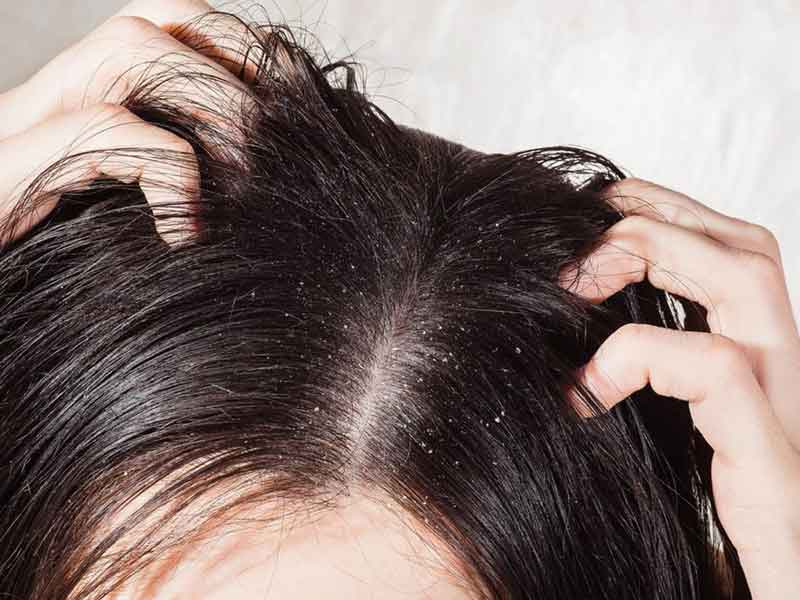 आपकी ये 5 आदतें डैमेज कर सकती हैं आपका स्कैल्प (खोपड़ी की त्वचा), बालों की जड़ों को पहुंचता है नुकसान 